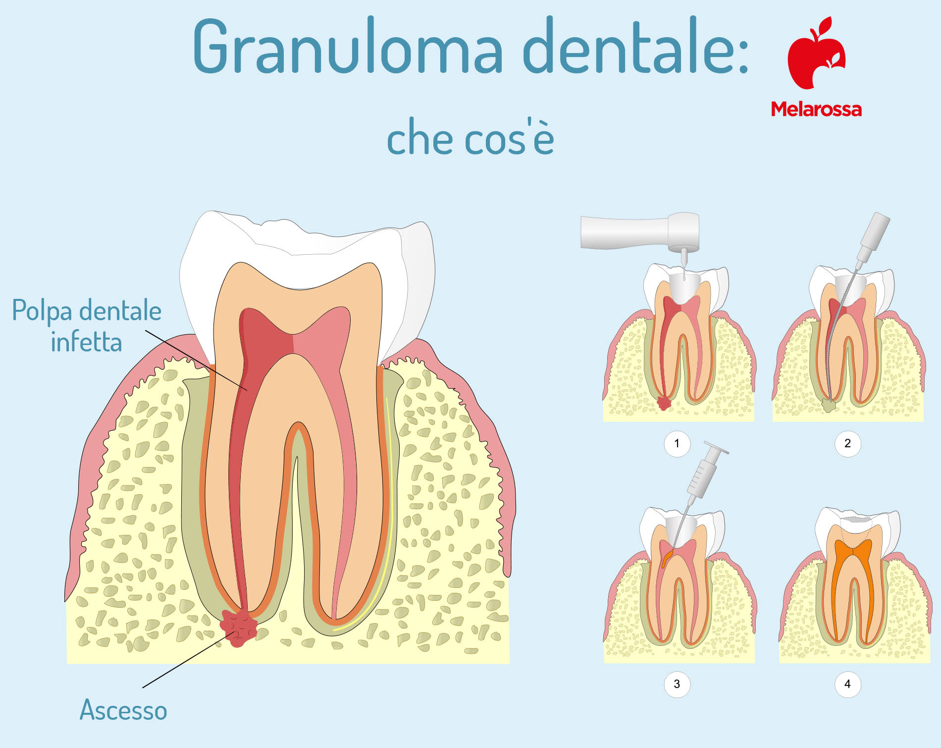 Granuloma dentale: cos’è, cause, sintomi, complicanze e come curare l’infezione 1 granuloma dentale, che cos'è