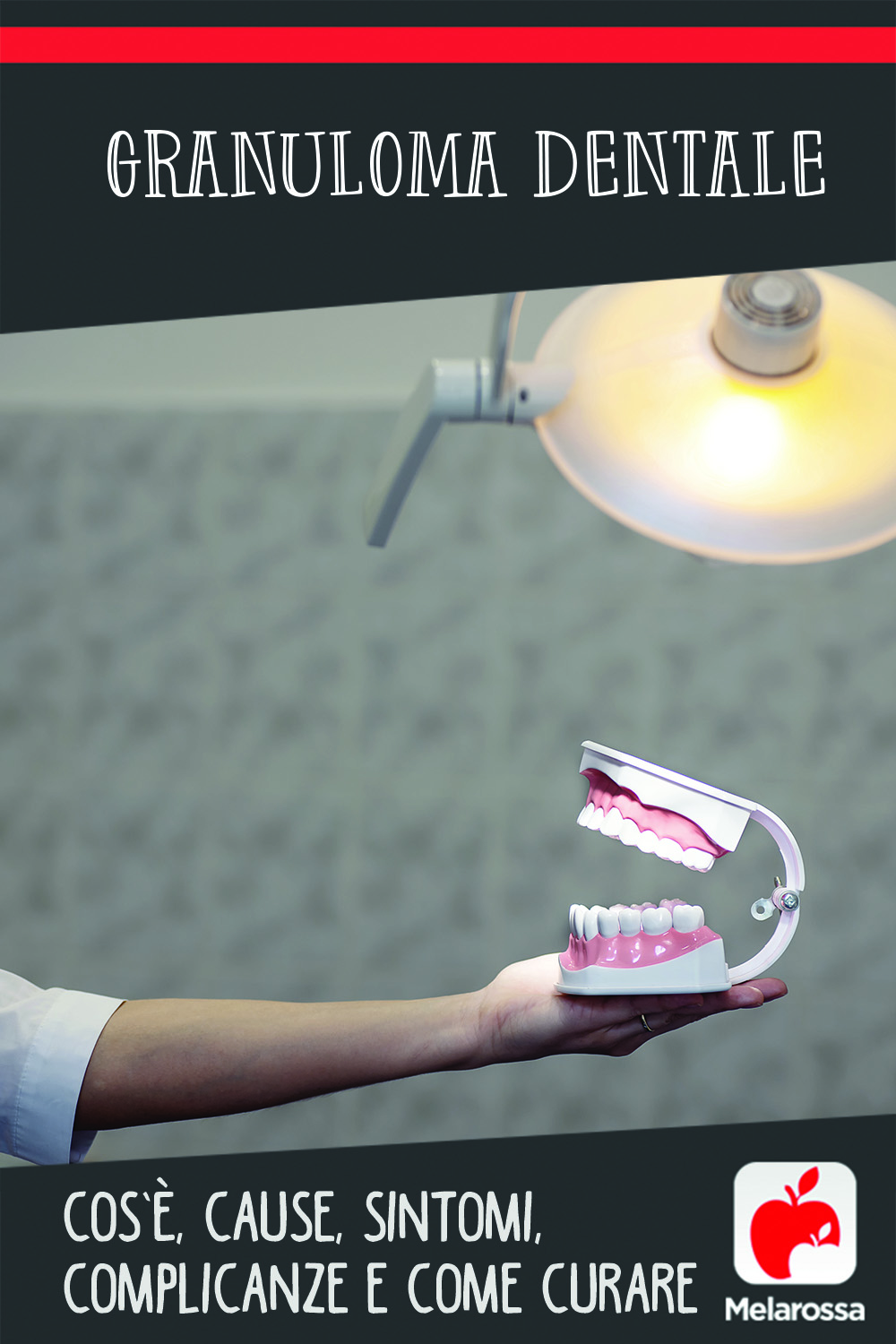 Granuloma dentale: cos’è, cause, sintomi, complicanze e come curare l’infezione 4 granuloma dentale