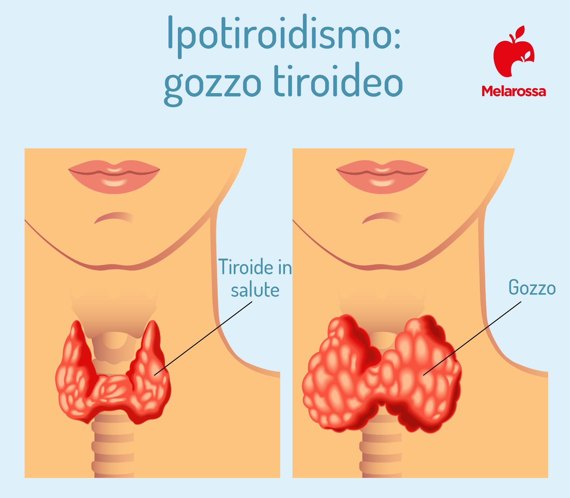 Ipotiroidismo: che cos’è, cause, sintomi, diagnosi, trattamento e dieta 2 ipotiroidismo: complicanze