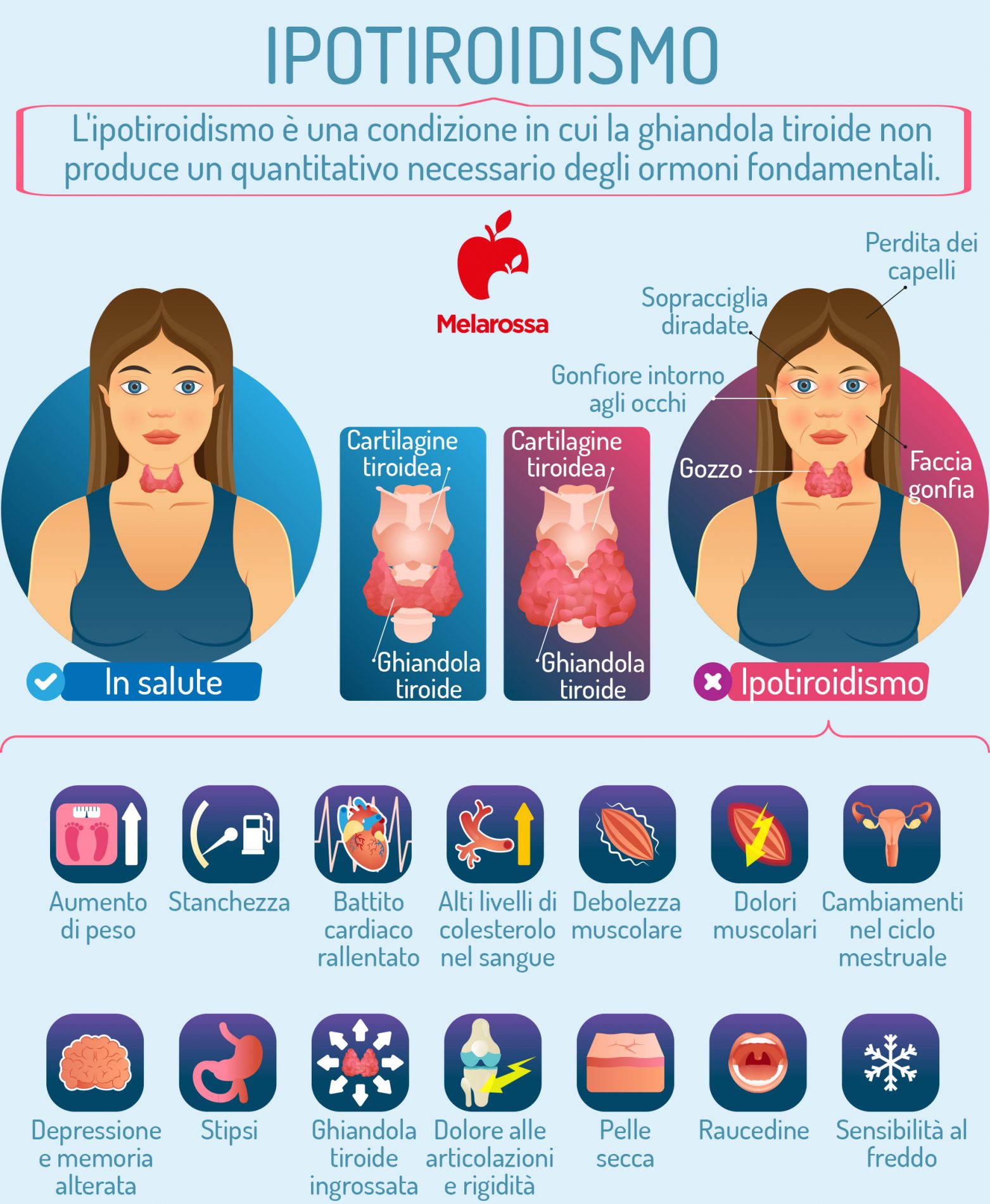 Ipotiroidismo: che cos’è, cause, sintomi, diagnosi, trattamento e dieta 1 ipotiroidismo: sintomi