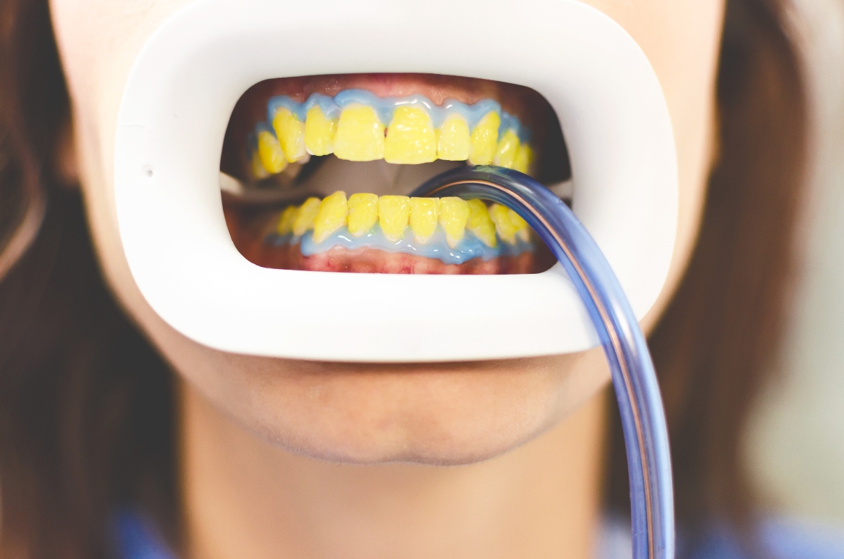 Sbiancamento denti: cos’è, come funziona, trattamenti, costo, risultati ed effetti collaterali 1 sbiancamento denti laser: come funziona