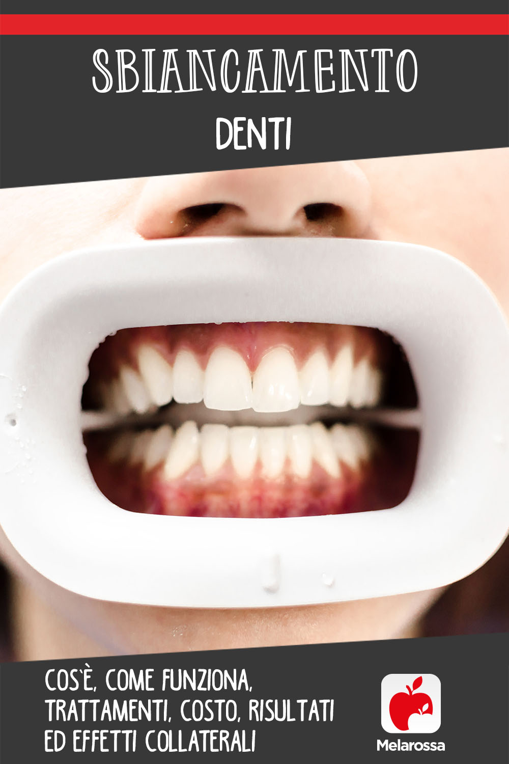 Sbiancamento denti: cos’è, come funziona, trattamenti, costo, risultati ed effetti collaterali 4 sbiancamento denti