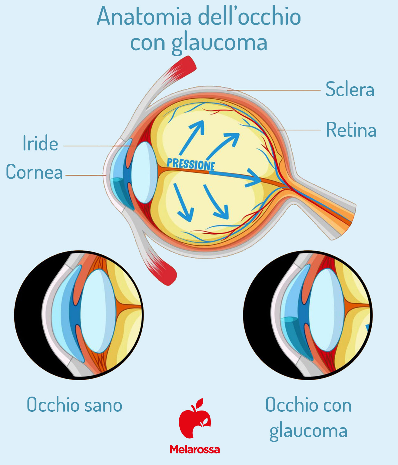 Uveite all’occhio: cos’è, quanti tipi esistono, cause, sintomi, diagnosi e cure 4 uveite: complicazioni