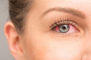 Uveite all&rsquo;occhio: cos&rsquo;&egrave;,  quanti tipi esistono, cause, sintomi, diagnosi e cure