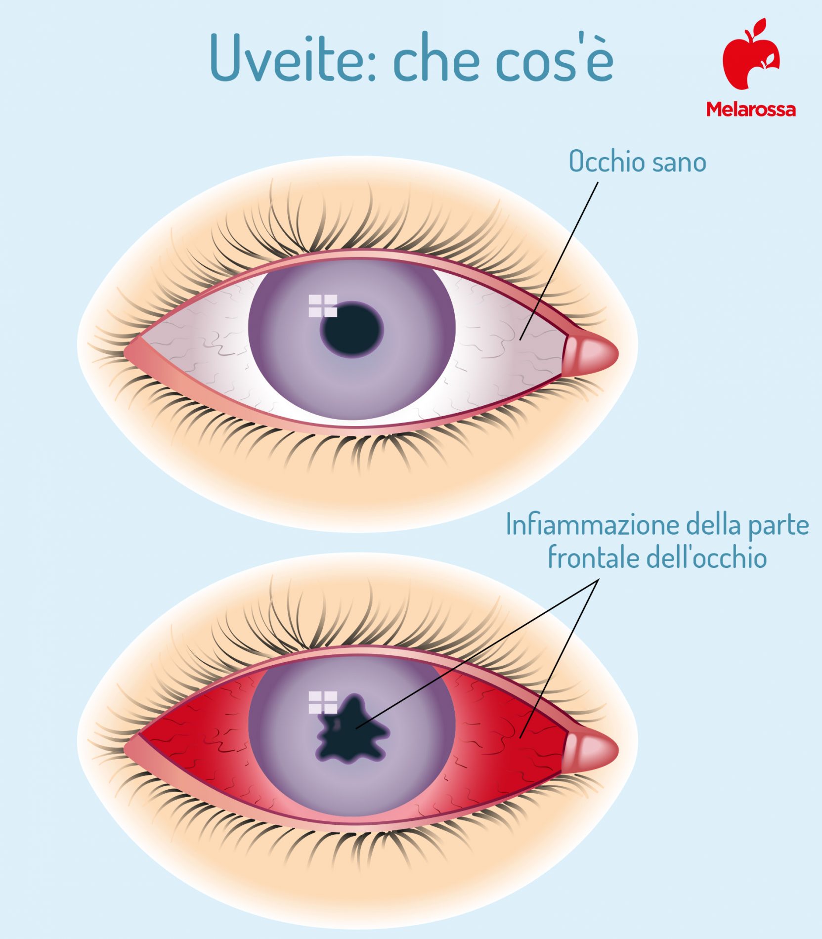 Uveite all’occhio: cos’è, quanti tipi esistono, cause, sintomi, diagnosi e cure 2 uveite: cos'è