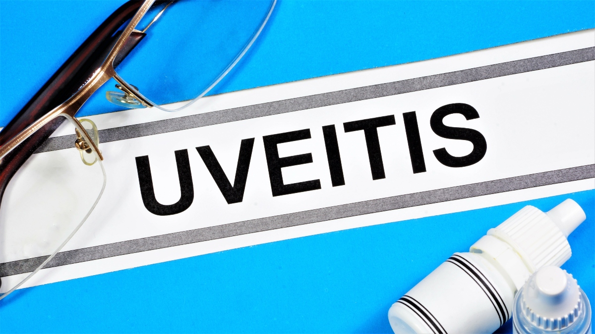 Uveite all’occhio: cos’è, quanti tipi esistono, cause, sintomi, diagnosi e cure 6 uveite: cure