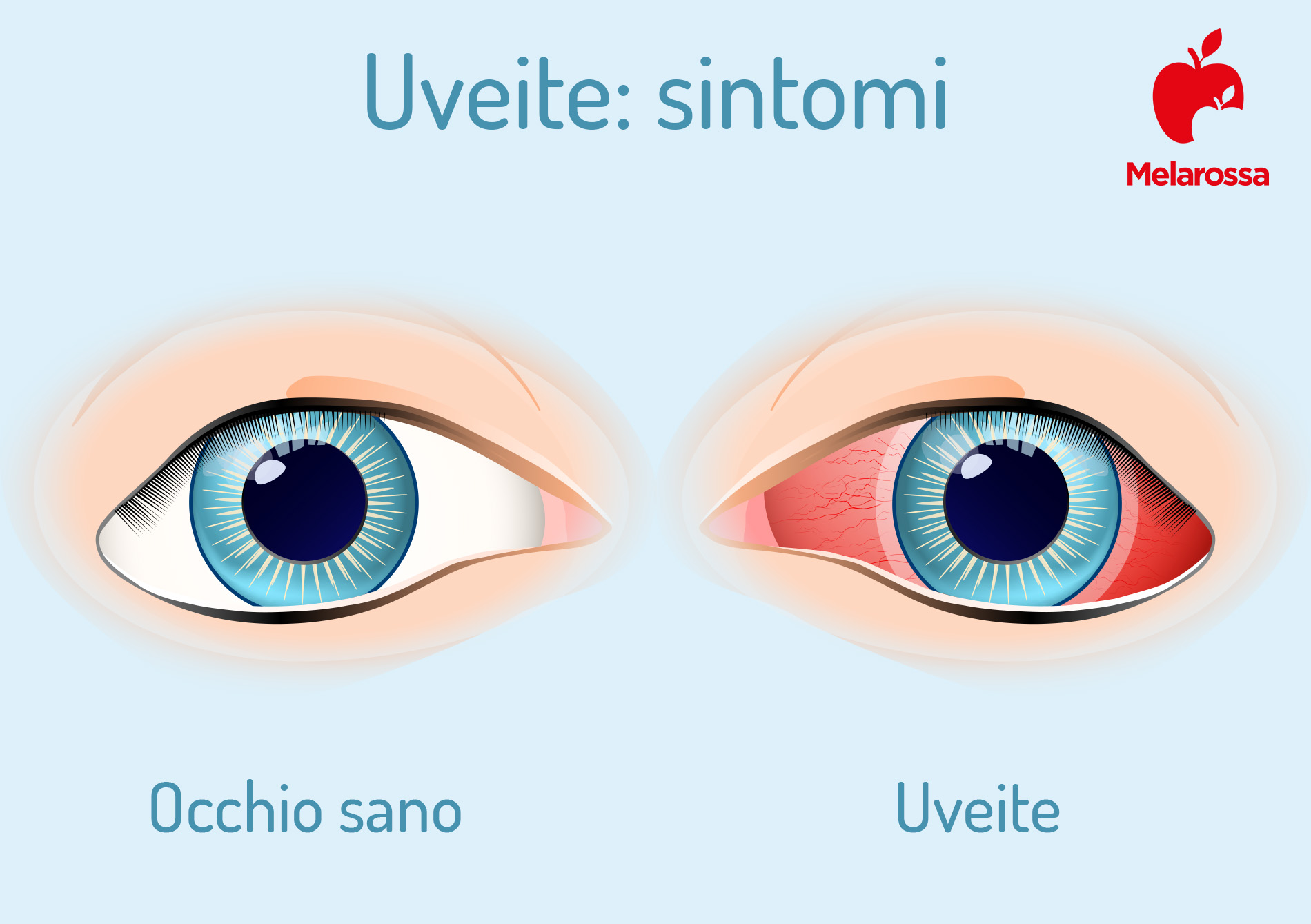 Uveite all’occhio: cos’è, quanti tipi esistono, cause, sintomi, diagnosi e cure 3 uveite: sintomi