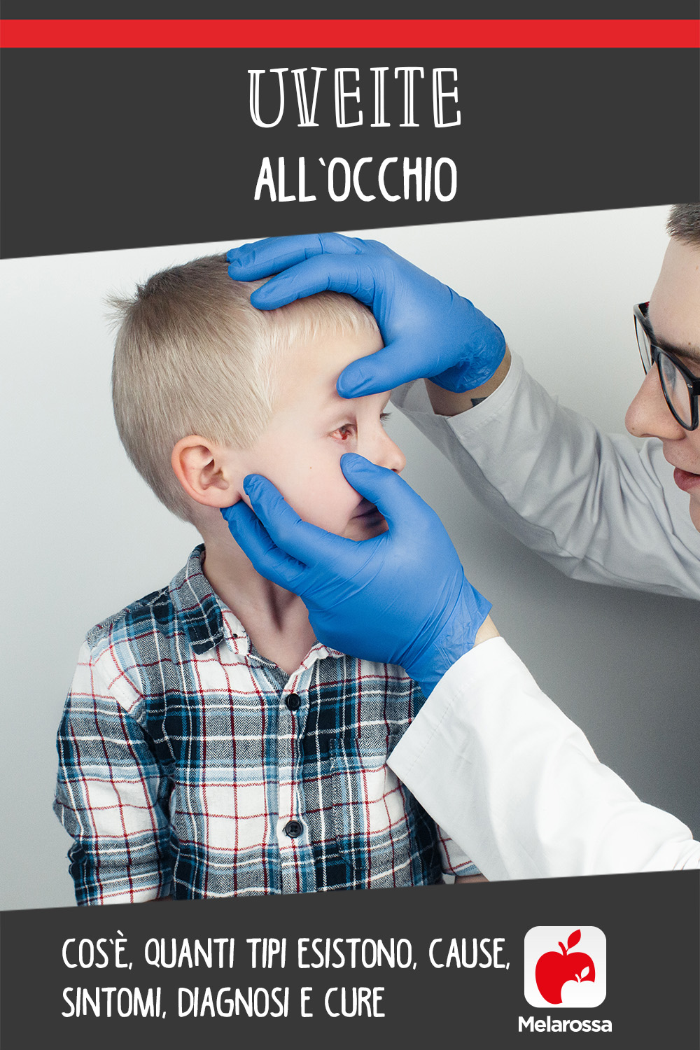 Uveite all’occhio: cos’è, quanti tipi esistono, cause, sintomi, diagnosi e cure 7 uveite