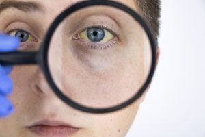 Anemia emolitica: che cos&rsquo;&egrave;, quanti tipi esistono, come si manifesta,  cause, diagnosi e cure