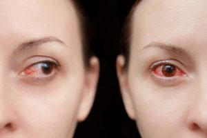 Distacco della retina: che cos&rsquo;&egrave;, tipologie, sintomi, cause, diagnosi e cure possibili