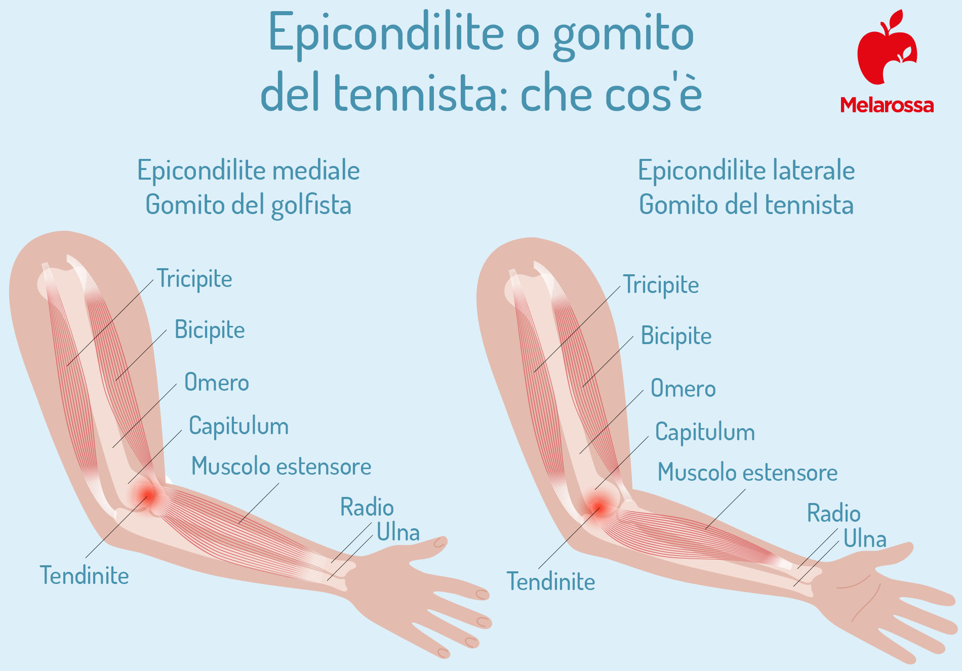 Epicondilite: cos’è, cause, sintomi, cura e rimedi del gomito del tennista 1 epicondilite o gomito del tennista: che cos'è