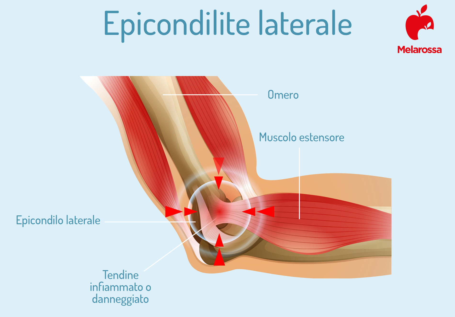 Epicondilite: cos’è, cause, sintomi, cura e rimedi del gomito del tennista 2 epicondilite laterale