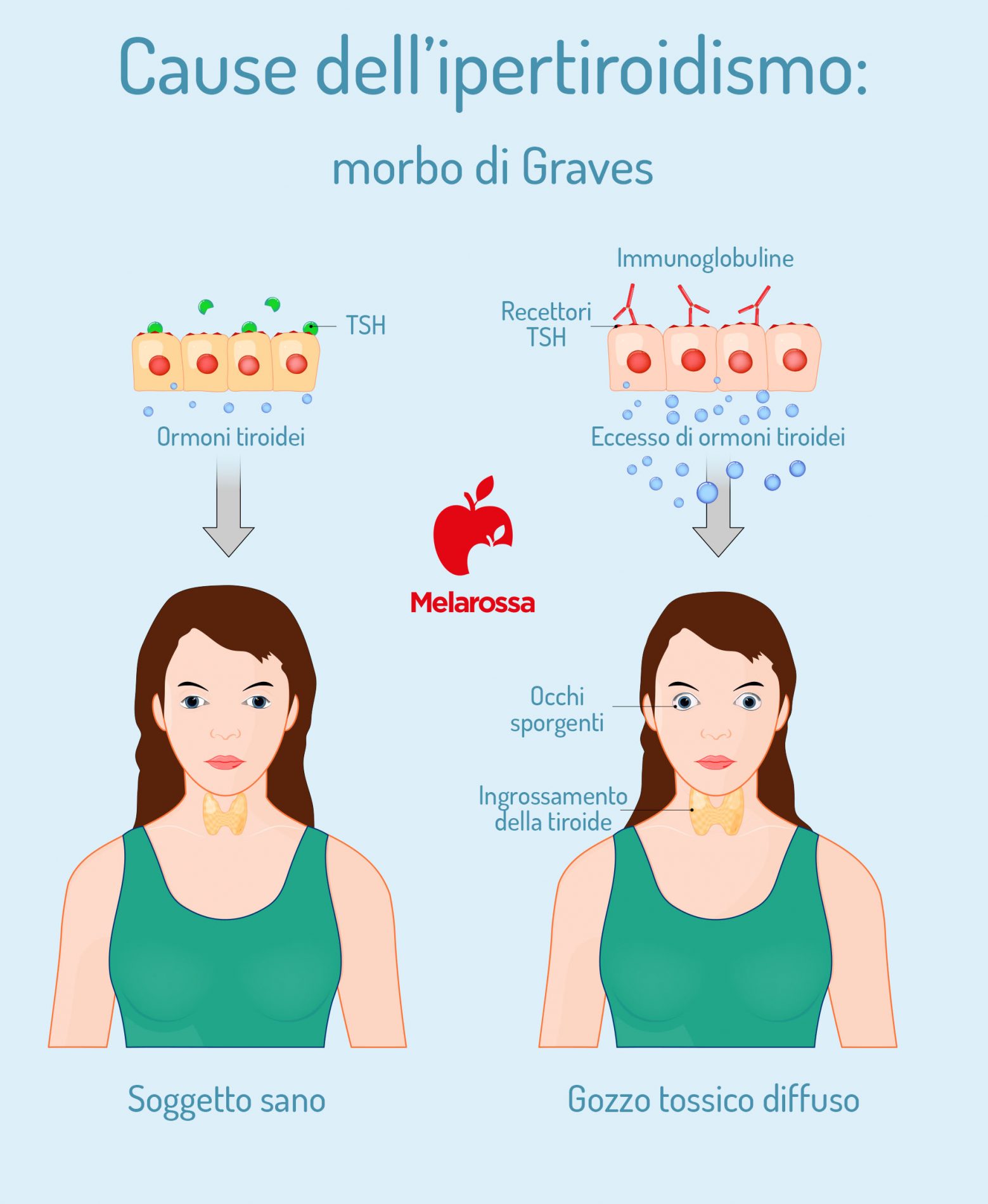 Ipertiroidismo: cos'è, cause, sintomi, diagnosi, cure e dieta 3 ipertiroidismo: cause