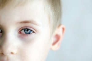 Cheratite oculare: cos&rsquo;&egrave;, sintomi,  cause,  diagnosi, cure e prevenzione