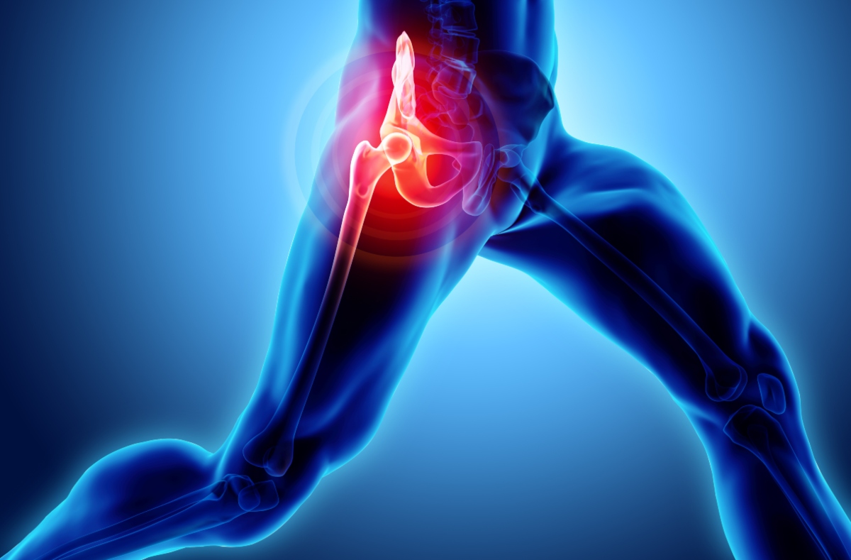 Coxalgia: cos'è, sintomi, cause, trattamento e cure del dolore all'anca 2 quali sono le cause della coxalgia