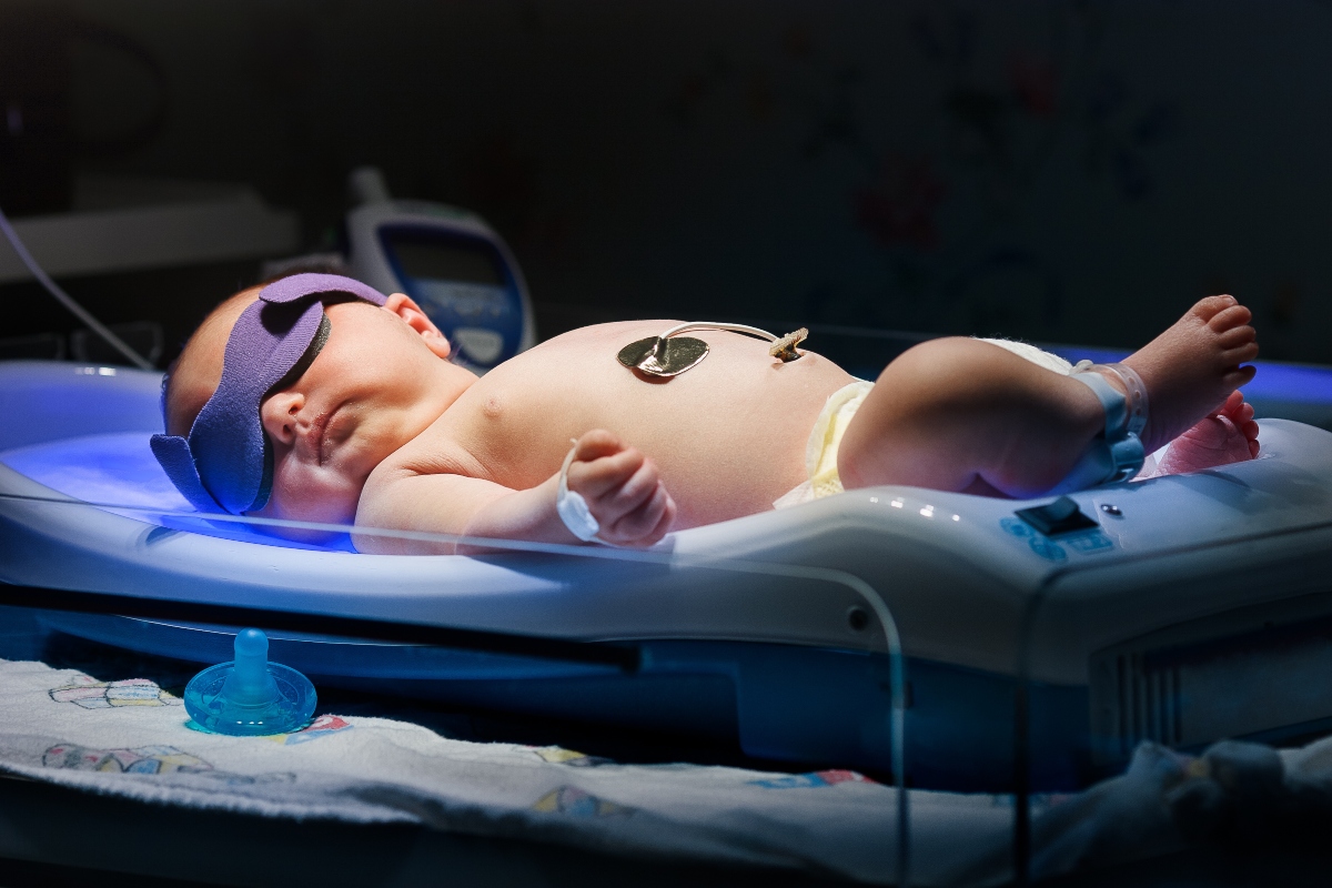 Ittero: cos’è, sintomi, tipologie, cause, diagnosi, cure e prevenzione 1 ittero neonatale