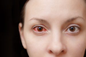 Sangue nell&rsquo;occhio: cos&rsquo;&egrave;, sintomi, cause, cosa fare e quando preoccuparsi