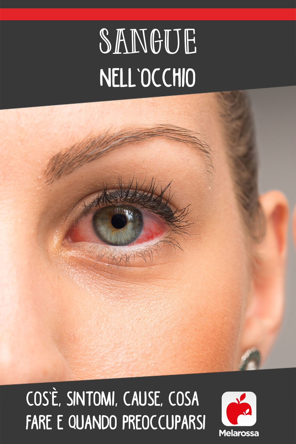 Sangue nell’occhio: cos’è, sintomi, cause, cosa fare e quando preoccuparsi 6 sangue nell'occhio: che cos'è, cause, sintomi e cure