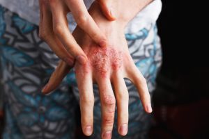 Psoriasi: cos&rsquo;&egrave;, sintomi, tipi, diagnosi, cause e cure