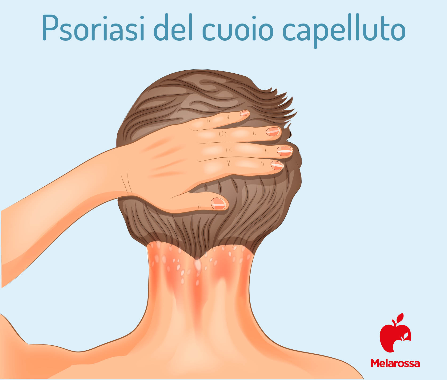 Psoriasi: cos'è, sintomi, tipi, diagnosi, cause e cure 3 psoriasi del cuoio capelluto