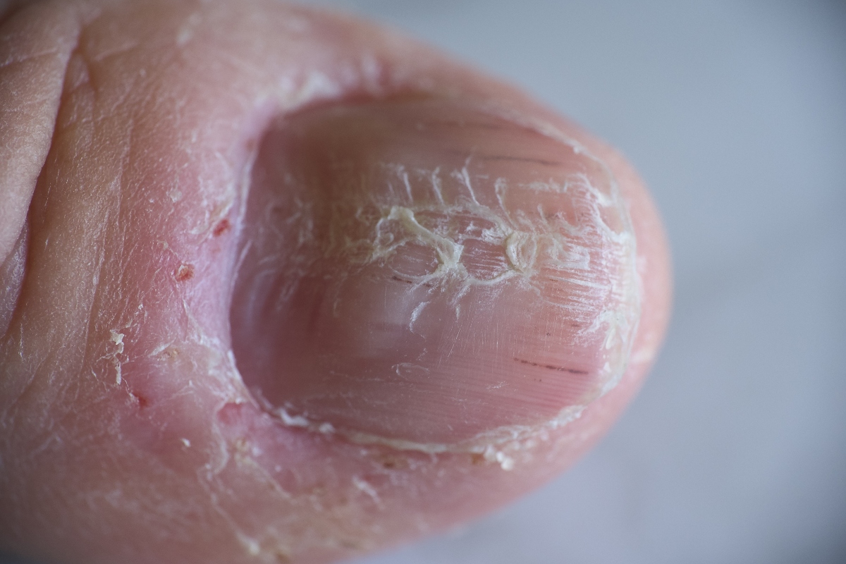 Psoriasi: cos'è, sintomi, tipi, diagnosi, cause e cure 2 psoriasi delle unghie: foto