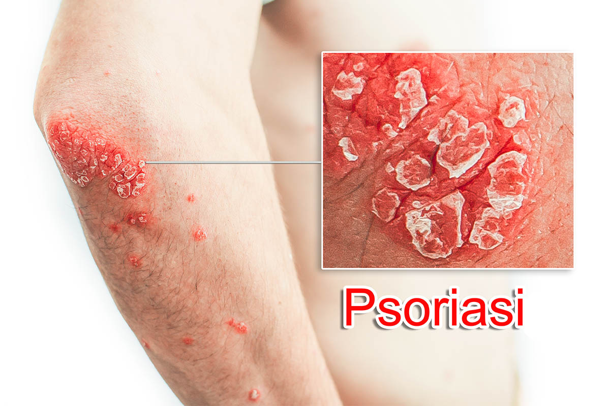 Psoriasi: cos'è, sintomi, tipi, diagnosi, cause e cure 5 psoriasi: foto