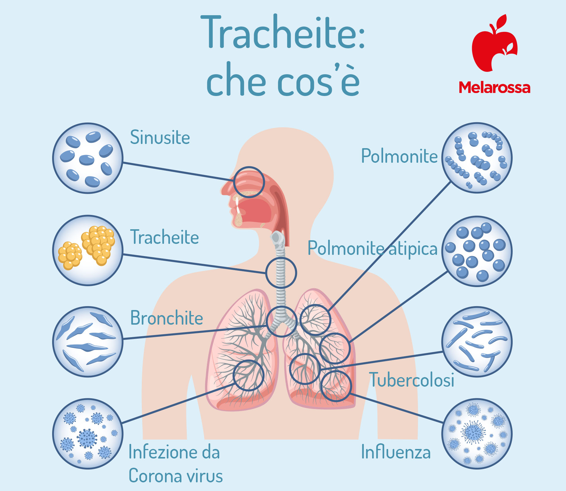Tracheite: cos’è, quali sono i sintomi e le cause, diagnosi, cura e rimedi naturali 1 tracheite: che cos'è