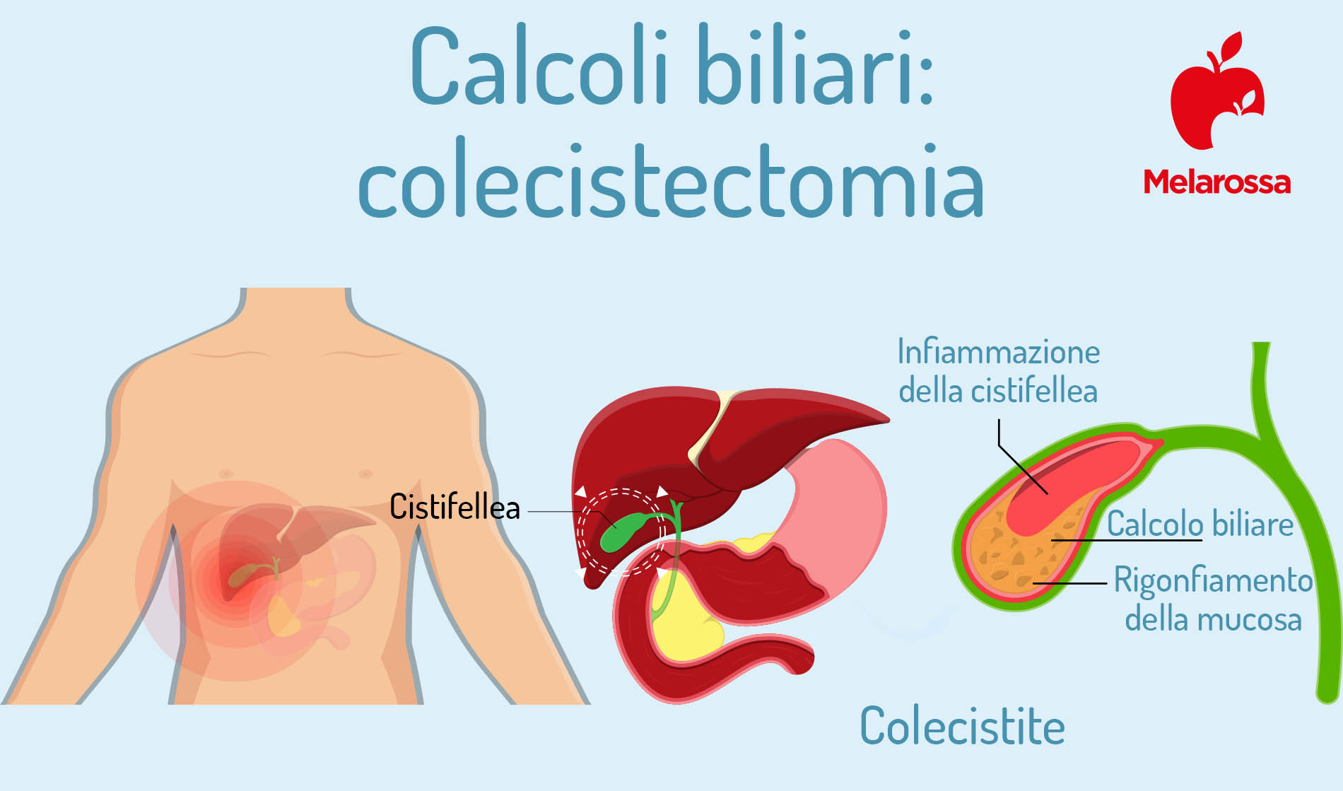 Calcoli biliari: cosa sono, classificazione, sintomi, cause, diagnosi e cura 5 calcoli biliari: colecistectomia