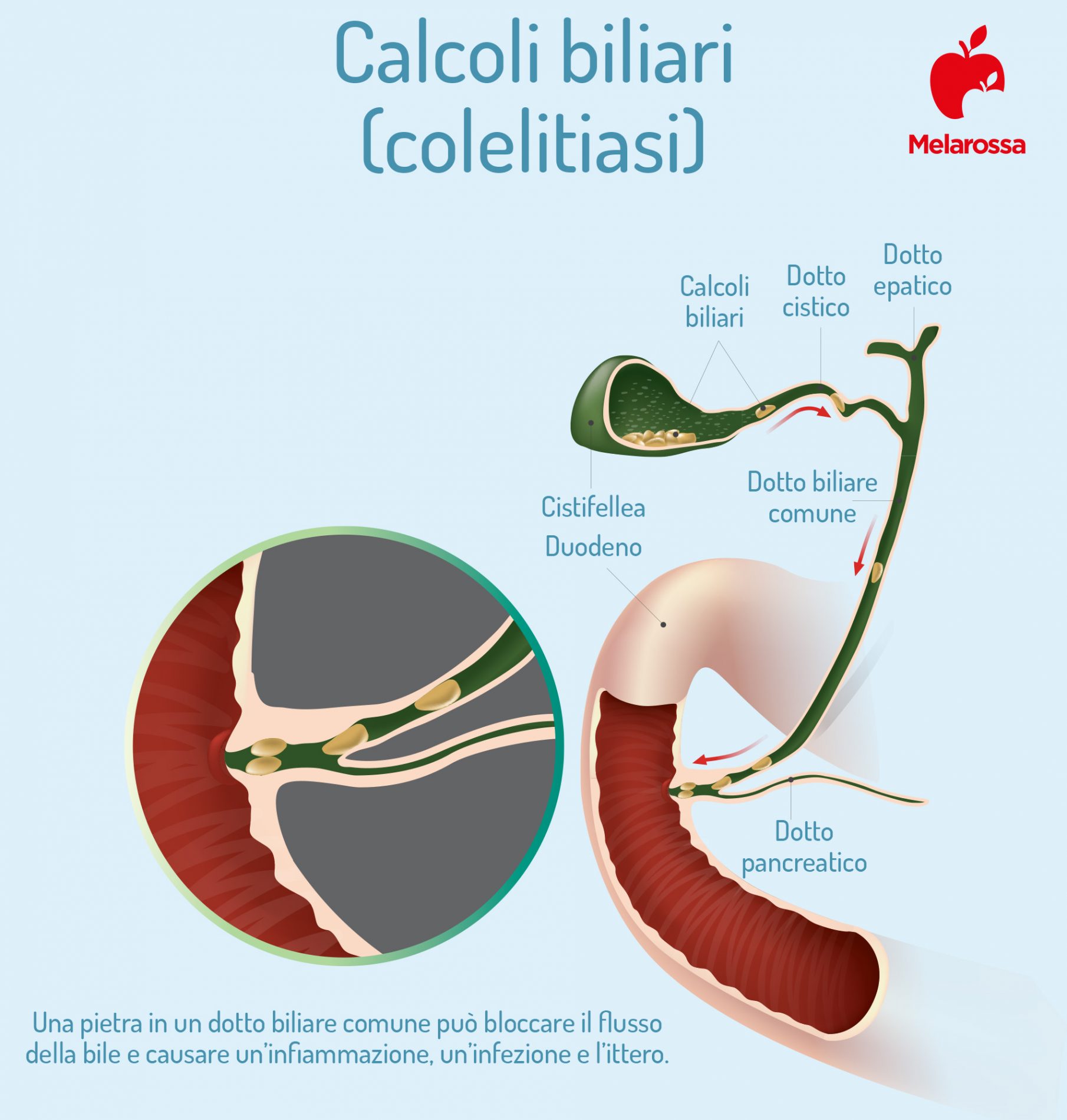 Calcoli biliari: cosa sono, classificazione, sintomi, cause, diagnosi e cura 7 calcoli biliari: cure
