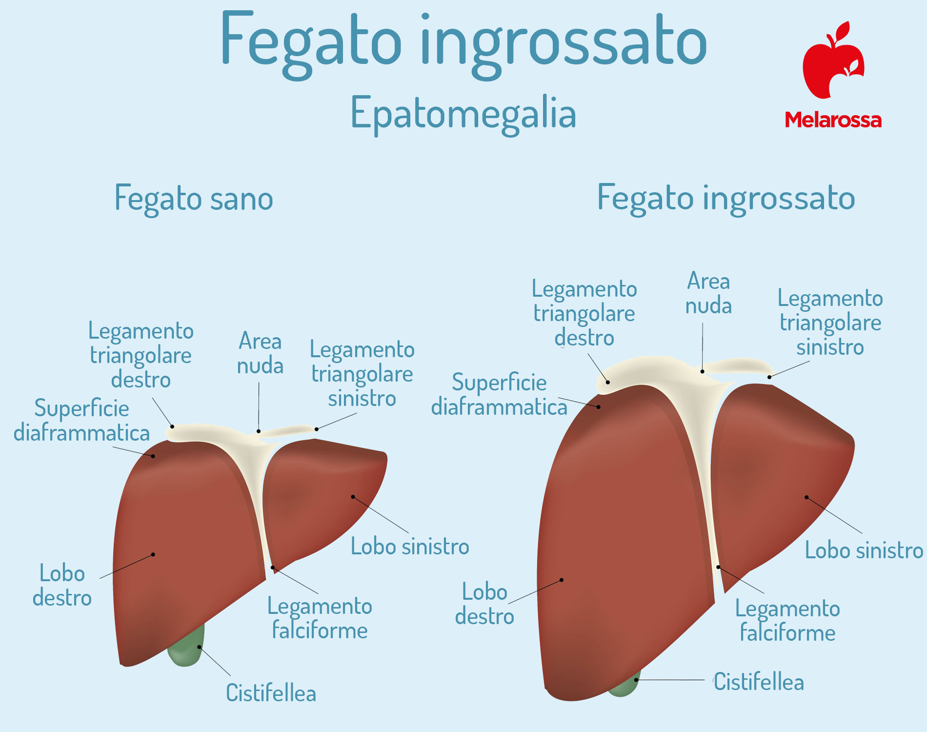 Fegato ingrossato o epatomegalia: cosa vuole dire, sintomi, cause, diagnosi, cura e rimedi 1 fegato ingrossato sintomi