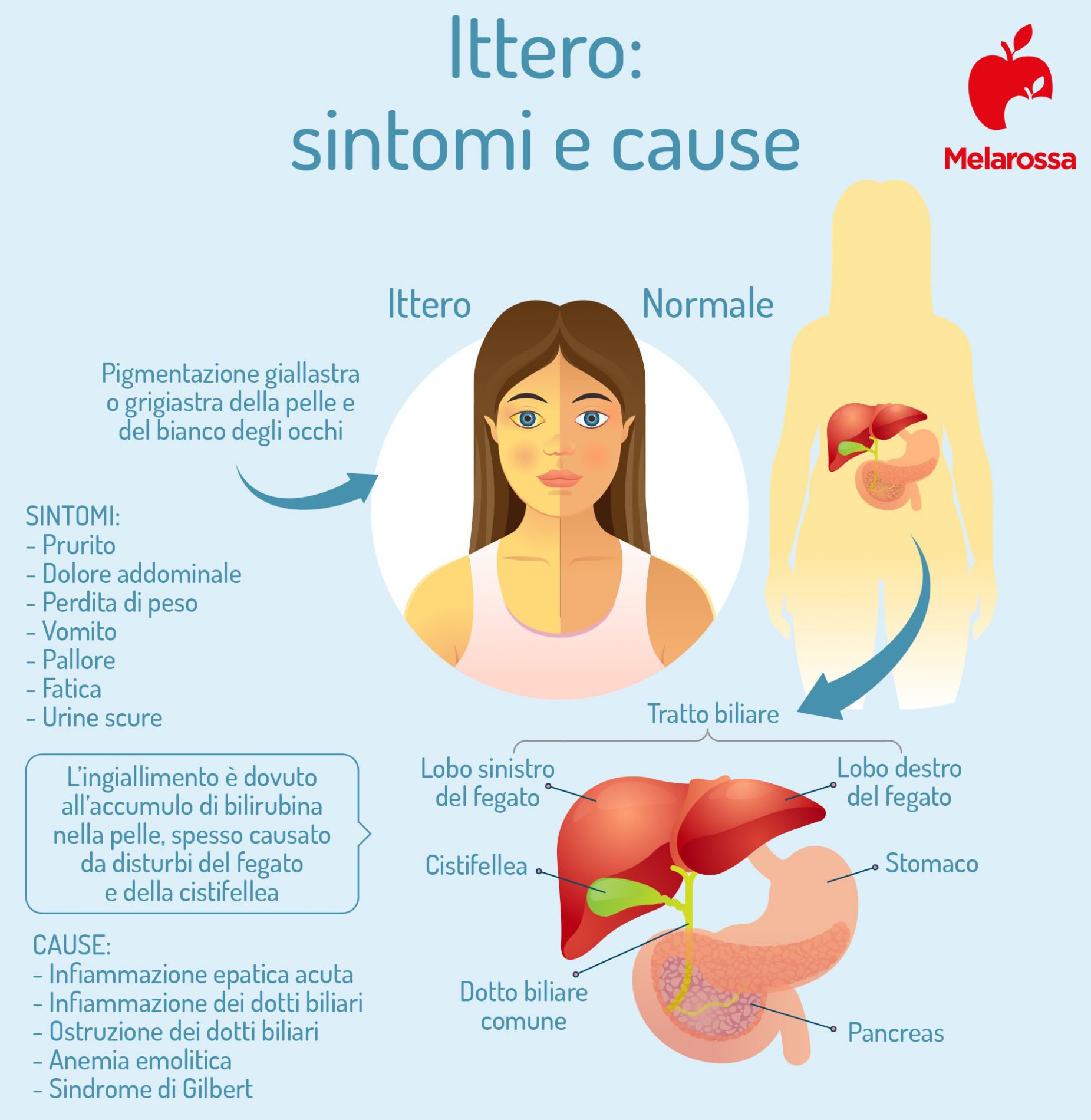 Tumore al fegato: cos’è, sintomi, cause, diagnosi e cure, e come prevenire 1 ittero: sintomo del tumore al fegato