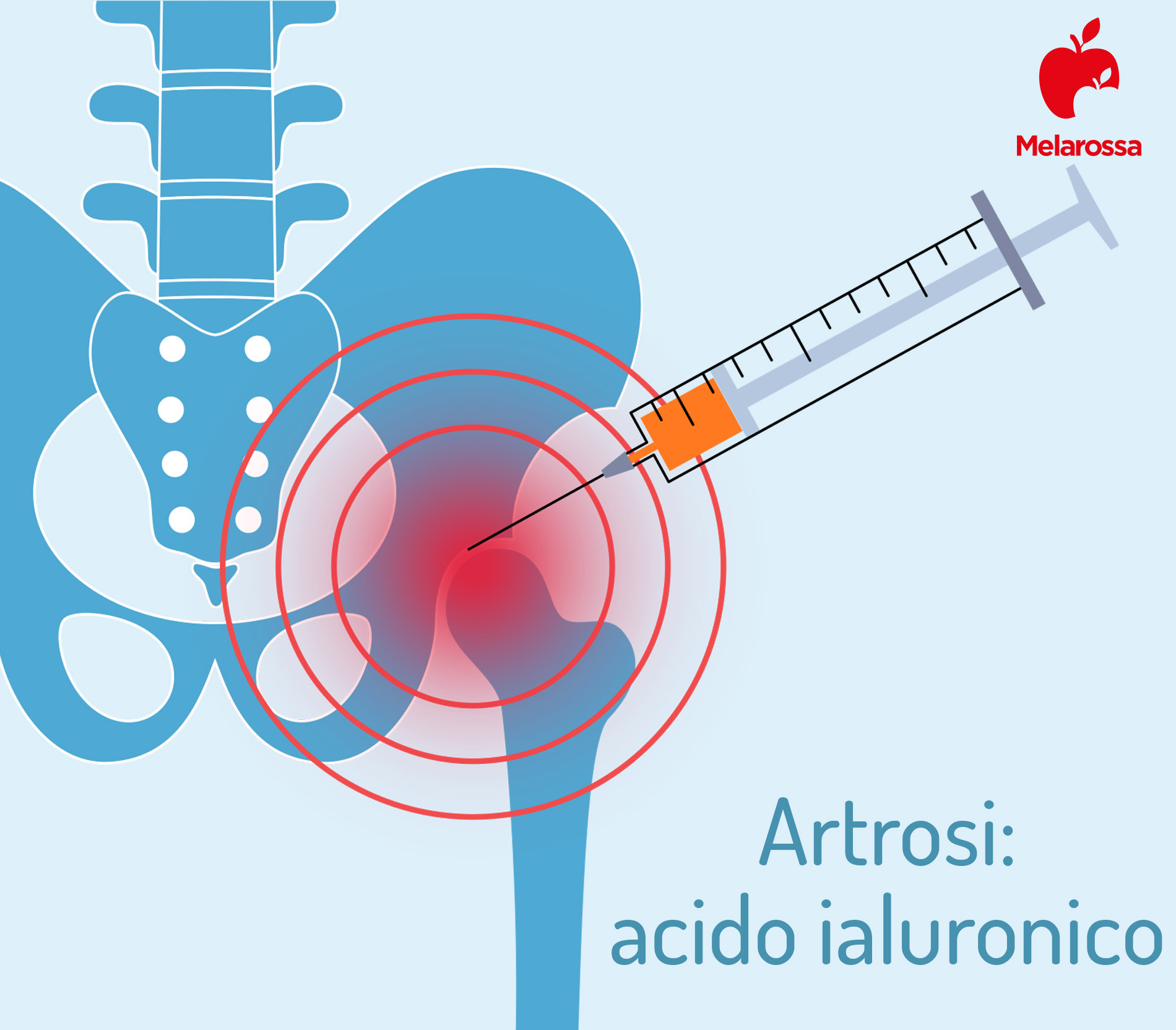 Artrosi: cos'è, sintomi, cause, diagnosi, come si cura, cosa mangiare e come convivere con la malattia 5 curare artrosi con acido ialuronico