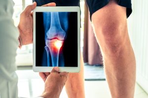 Artrosi: cos&rsquo;&egrave;, sintomi, cause, diagnosi, come si cura, cosa mangiare e come convivere con la malattia