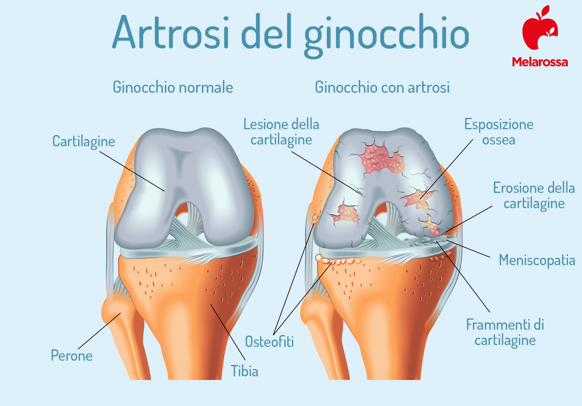 Artrosi: cos'è, sintomi, cause, diagnosi, come si cura, cosa mangiare e come convivere con la malattia 1 artrosi: ginocchio