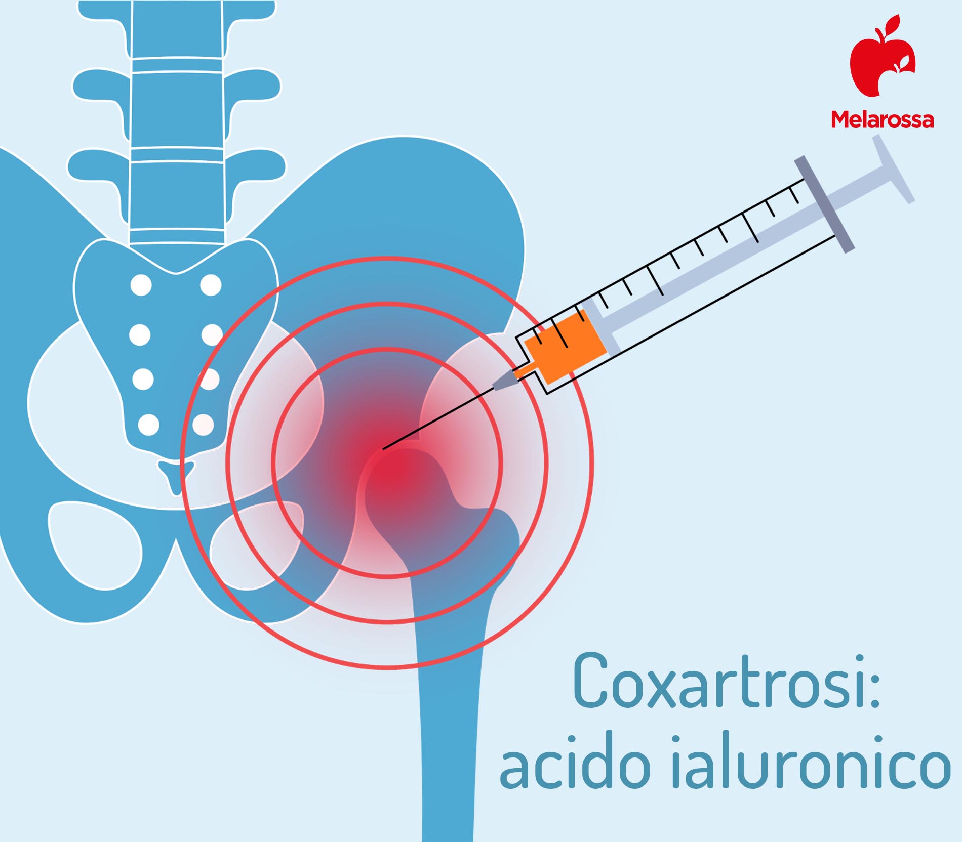 Coxartrosi: cos'è, cause, sintomi, diagnosi e cure dell'artrosi dell'anca 6 coxartrosi e acido ialuronico