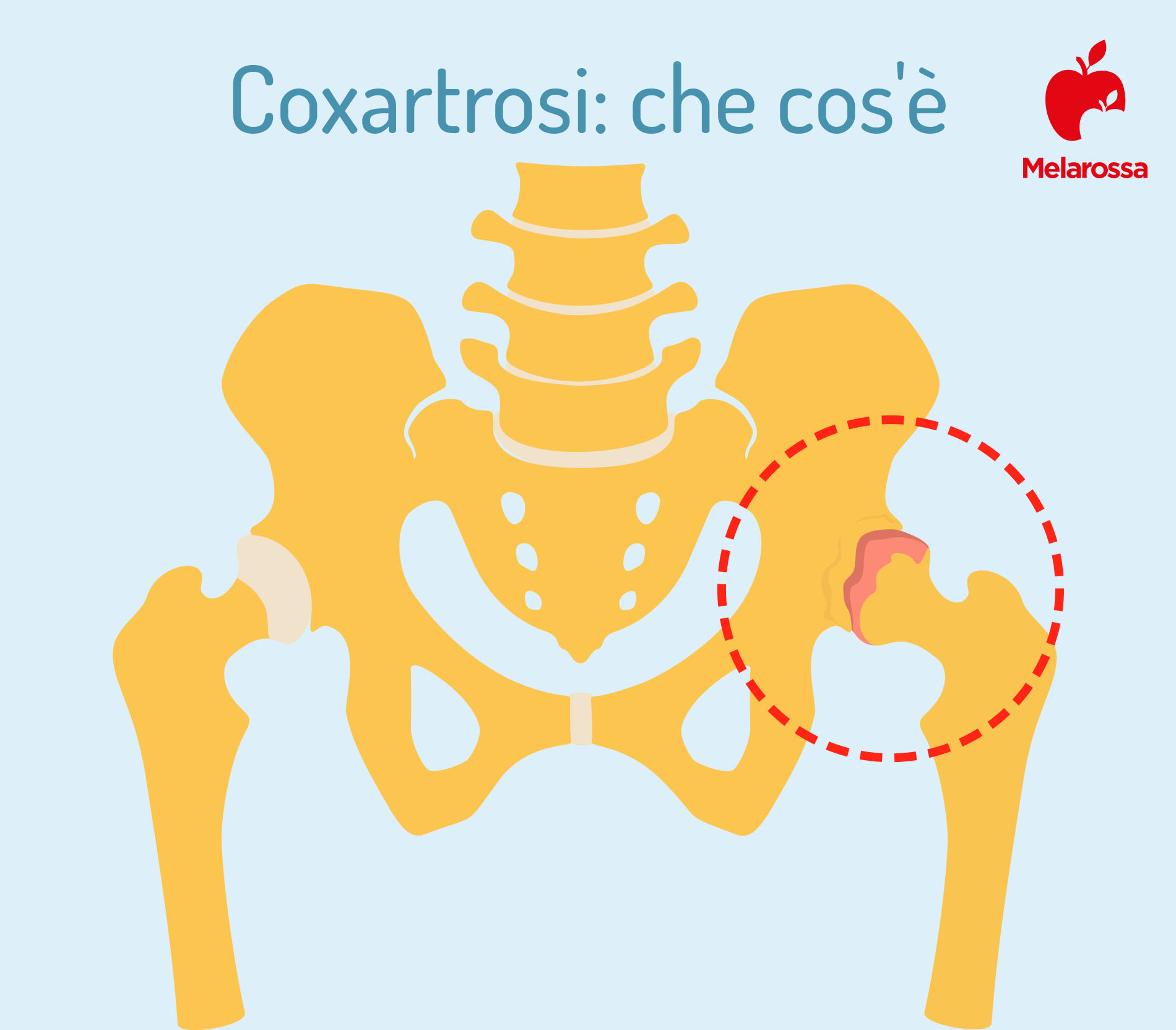 Coxartrosi: cos'è, cause, sintomi, diagnosi e cure dell'artrosi dell'anca 1 coxartrosi: che cos'è