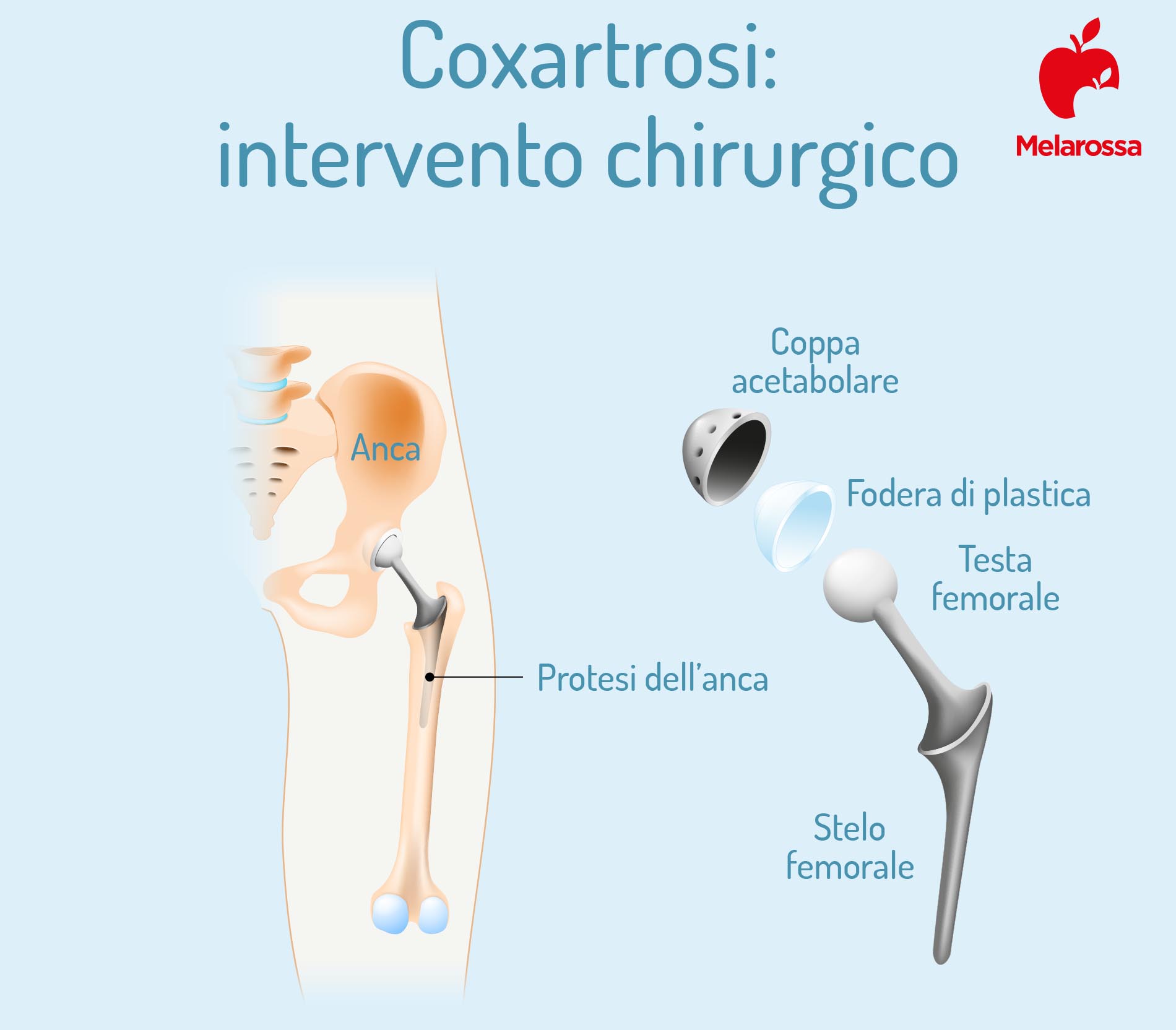 Coxartrosi: cos'è, cause, sintomi, diagnosi e cure dell'artrosi dell'anca 7 coxartrosi: protesi dell'anca
