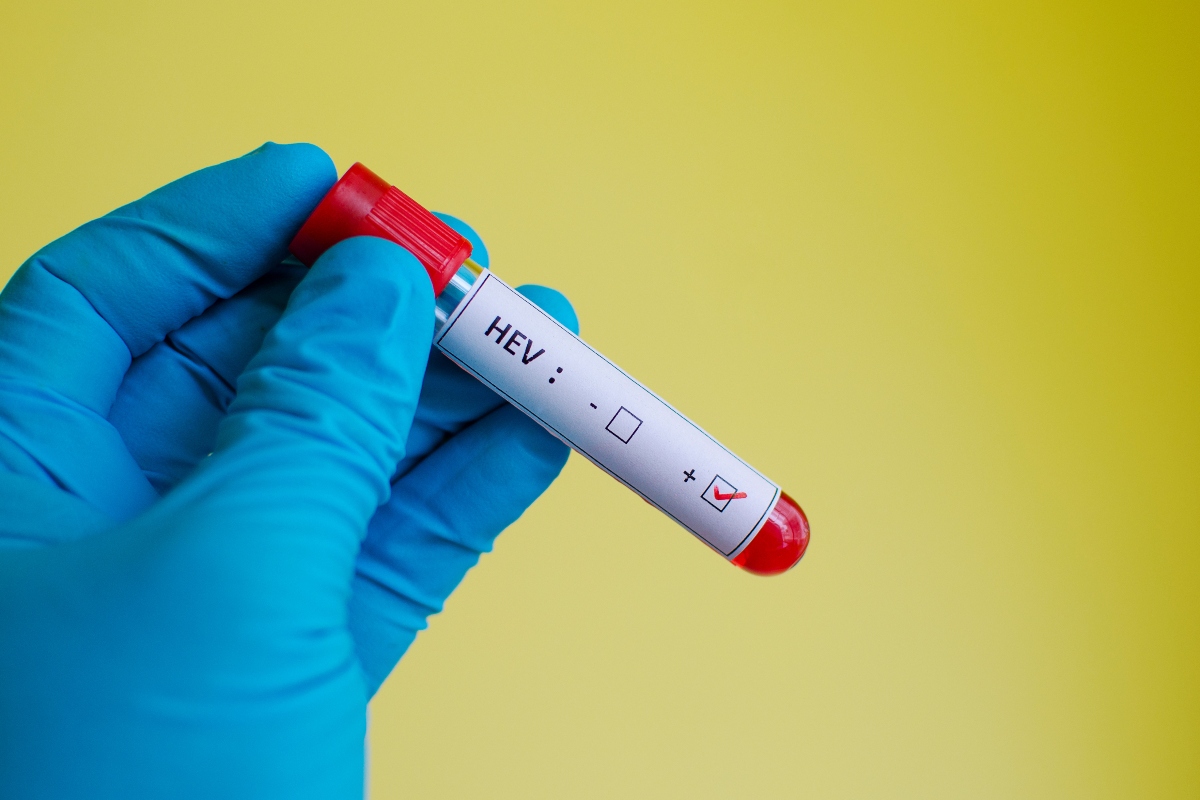 Epatite E: cos’è, come si trasmette, sintomi, cause e soggetti a rischio, cure e trattamenti, possibili complicazioni 3 diagnosi: epatite E