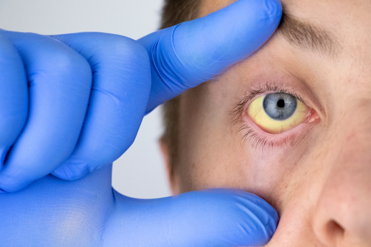Epatite E: cos’è, come si trasmette, sintomi, cause e soggetti a rischio, cure e trattamenti, possibili complicazioni 2 epatite E: diagnosi