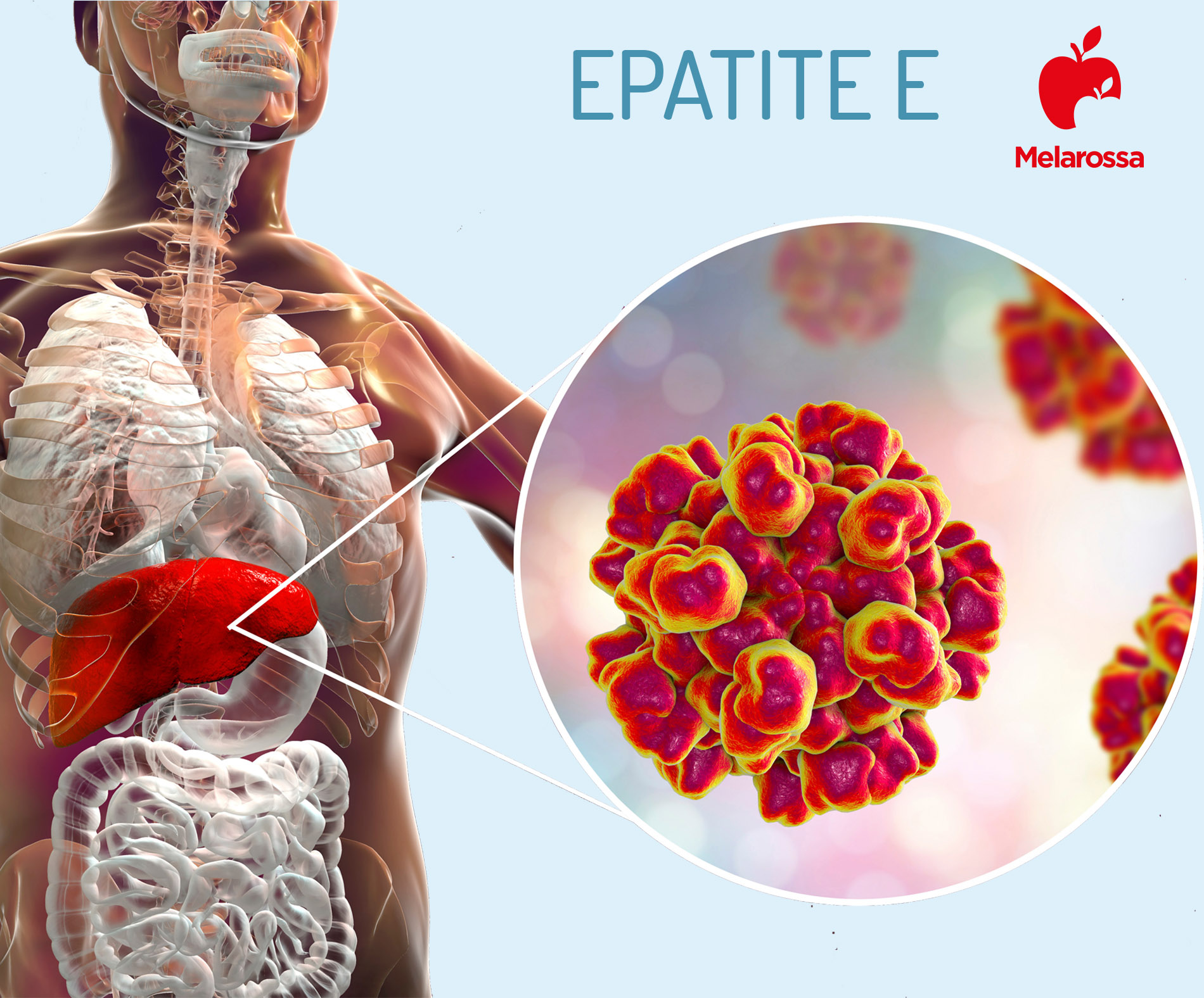 Epatite E: cos’è, come si trasmette, sintomi, cause e soggetti a rischio, cure e trattamenti, possibili complicazioni 1 epatite E: che cos'è