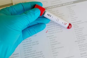 Epatite E: cos&rsquo;&egrave;, come si trasmette, sintomi, cause e soggetti a rischio,&nbsp;cure e trattamenti, possibili complicazioni