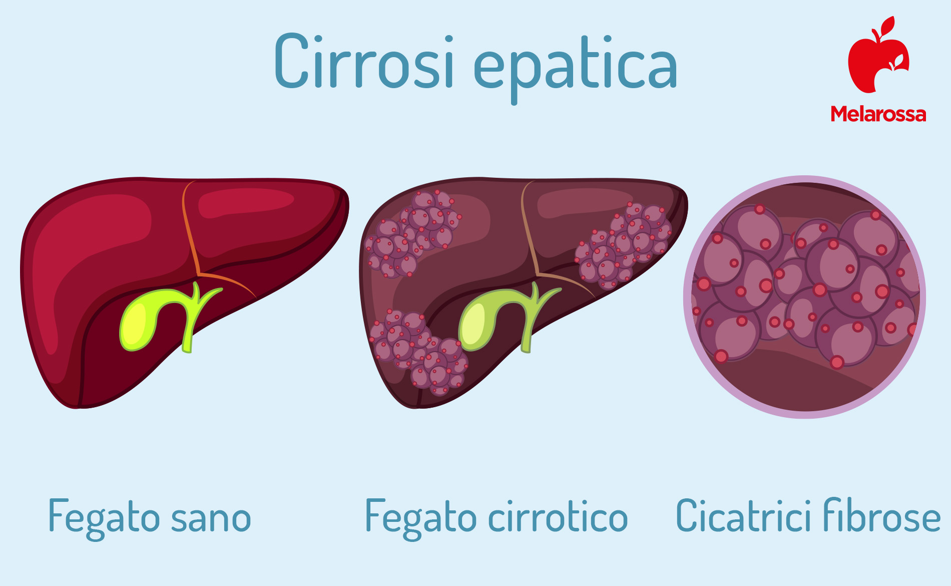 Fegato: dove si trova, quando preoccuparsi e sintomi se non funziona bene 3 Grafica sulla cirrosi epatica