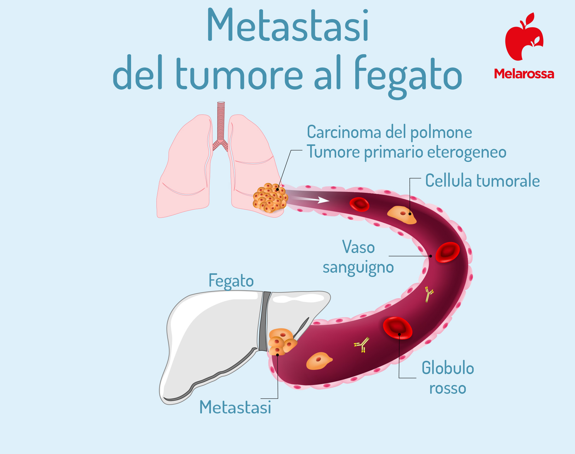Fegato: dove si trova, quando preoccuparsi e sintomi se non funziona bene 2 Grafica sul tumore al fegato
