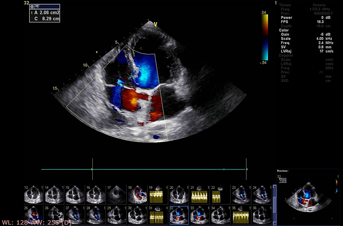 Miocardite: cos’è, sintomi, cause, diagnosi e cura 5 diagnosi miocardite
