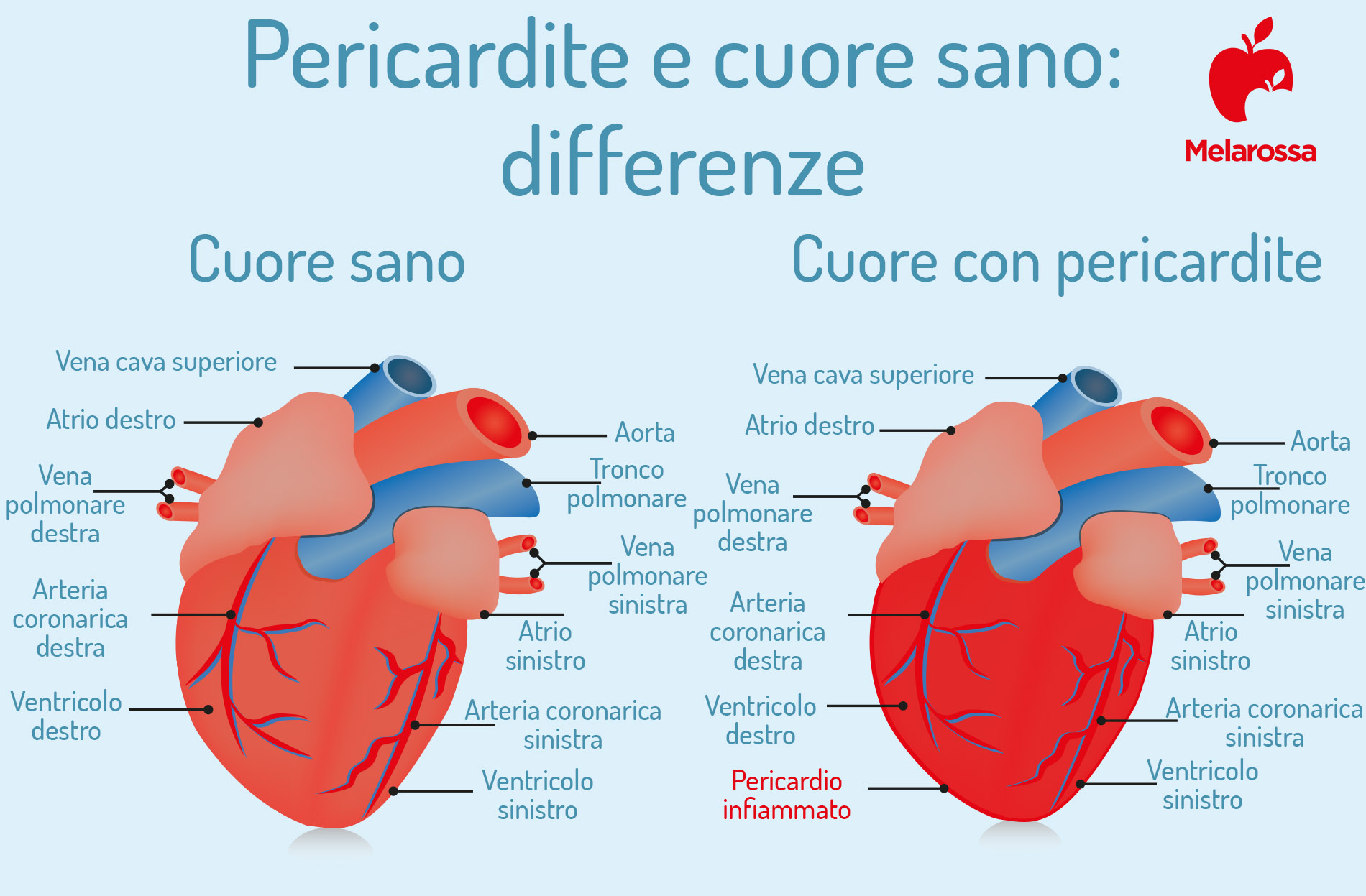 Pericardite: cos'è, sintomi, cause, diagnosi e cura 5 Pericardite: differenze con cuore sano