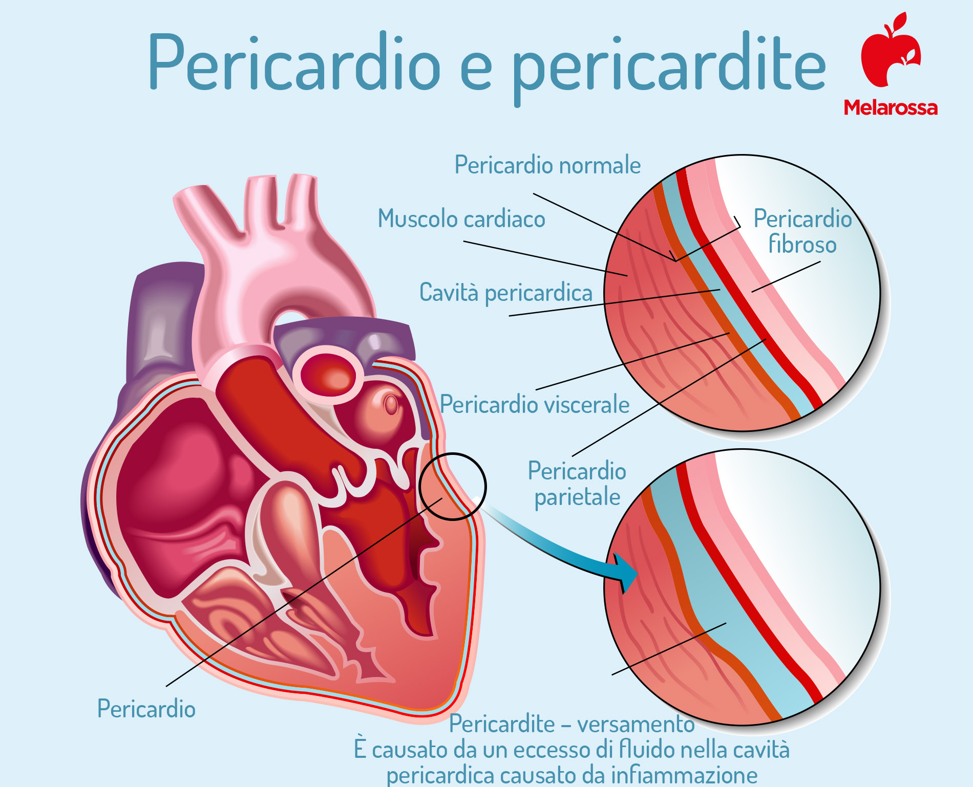 Pericardite: cos'è, sintomi, cause, diagnosi e cura 1 pericardite e pericardio
