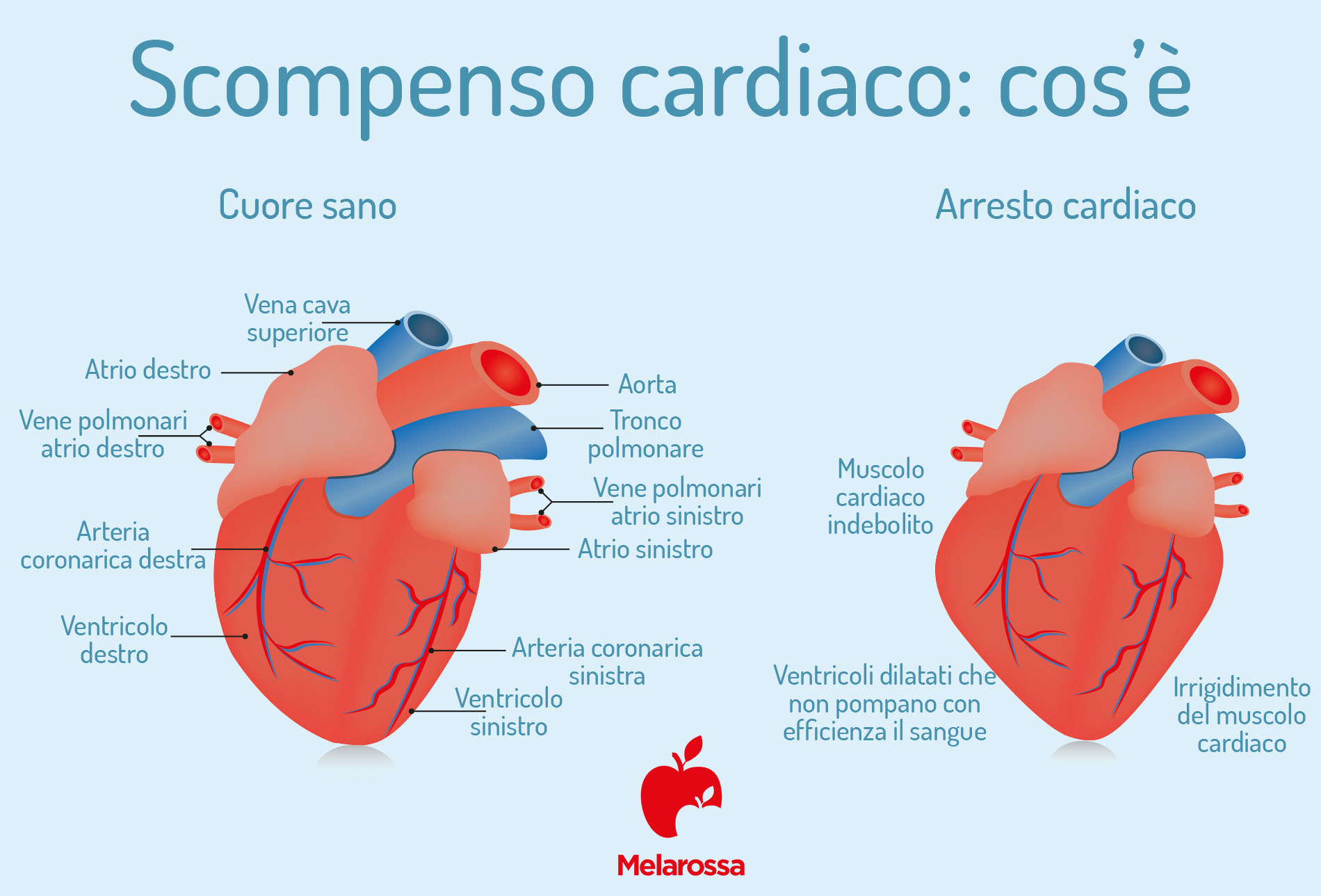Scompenso cardiaco: cos’è, tipologie, sintomi, cause, diagnosi e terapia 5 scompenso cardiaco: diagnosi
