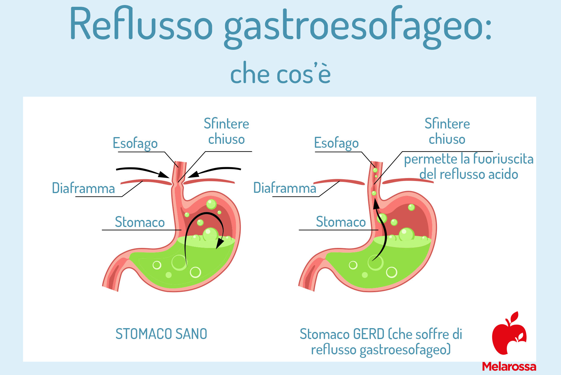 Reflusso gastroesofageo: cos'è, cause, sintomi, cure e rimedi 1 reflusso gastroesofageo: che cos'è