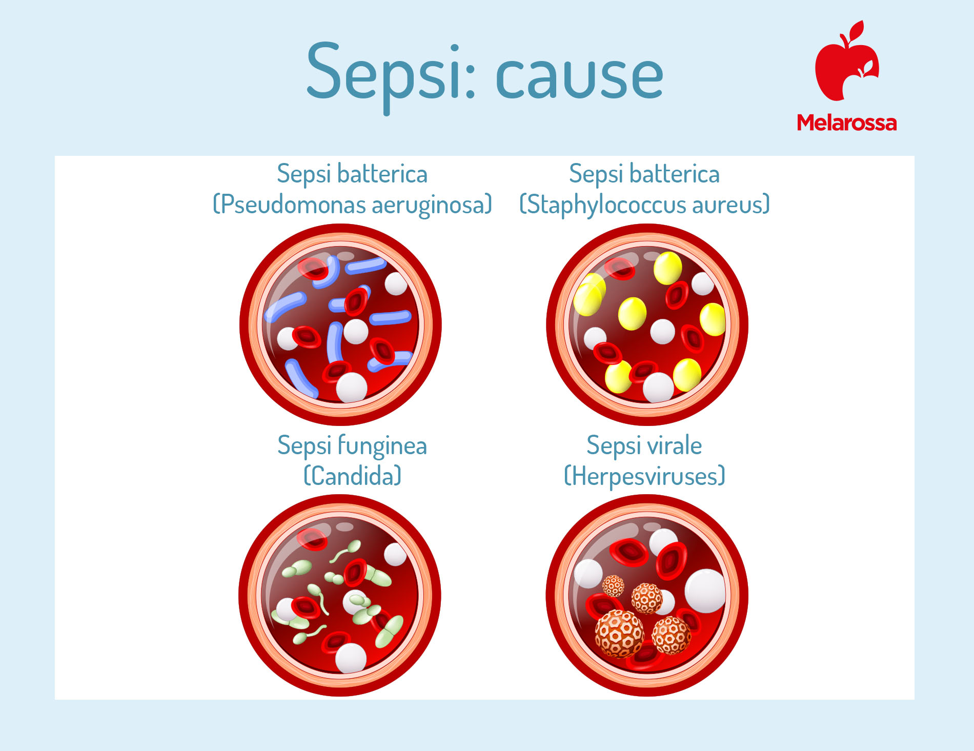 Setticemia: cos'è, sintomi, cause, cure e conseguenze della sepsi 3 Sepsi: cause