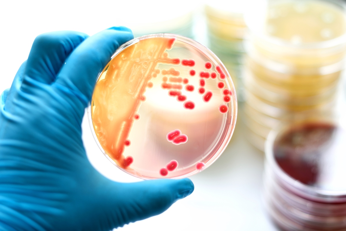 Setticemia: cos'è, sintomi, cause, cure e conseguenze della sepsi 6 Setticemia: diagnosi